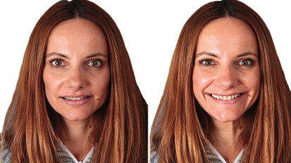 Fig. 2b: Fotografías extraorales después del tratamiento de ortodoncia.