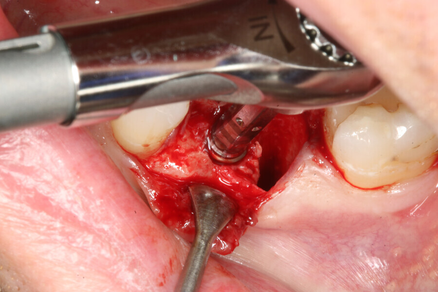 Fig. 3: Placement of implant.