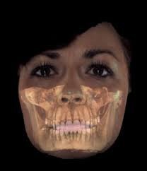 Fig. 4 - Esempio di sovrapposizione dei dati TAC sulla realtà clinica del paziente.