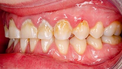 Interview: “Current antimicrobial techniques are largely ineffective ”