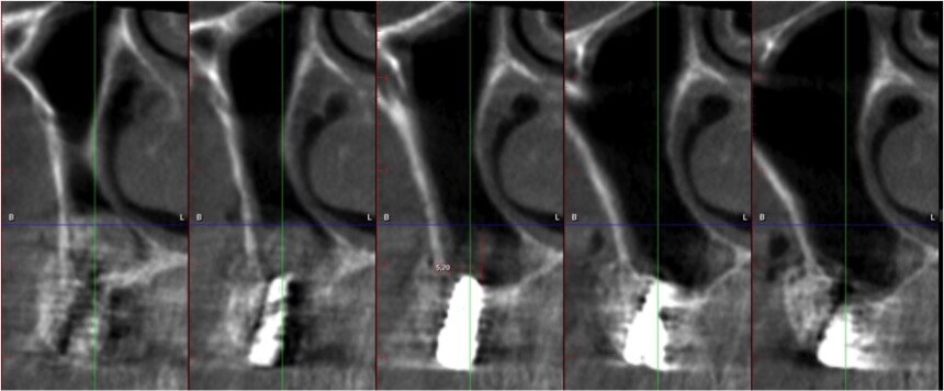 Fig. 14 - Sezione cross section post-operatia zona 24.