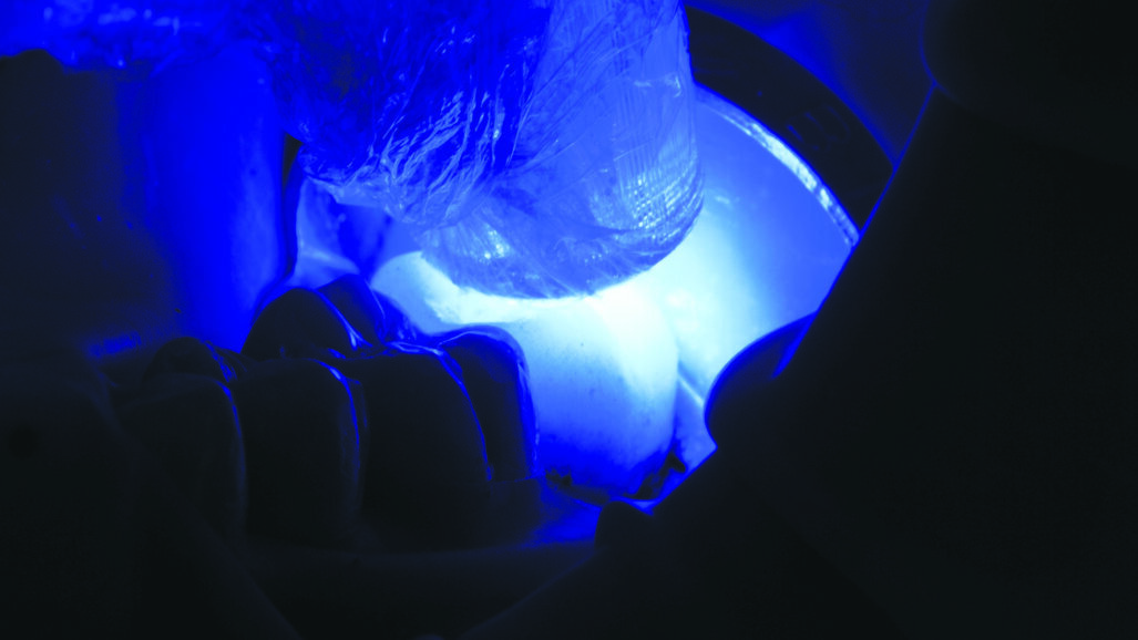 3M™ RelyX™ Ultimate Adhesive Resin  Cement – Posterior Crown