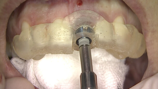 Il razionale del posizionamento implantare tridimensionale protesicamente guidato nei settori estetici