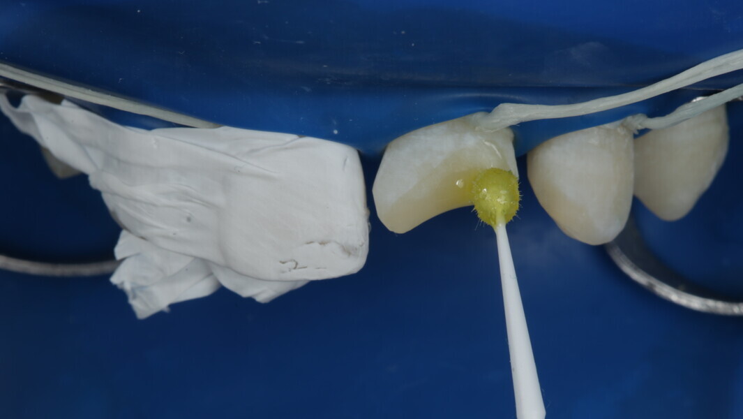 Fig 13: A single bond universal from 3M was used as the adhesive. The bond was applied in scrubbing motion for 10 seconds and the excess was removed with a fresh applicator tip and light cured.