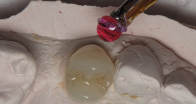Cementazione di corona facilitata  dal dispositivo Triodent Griptab