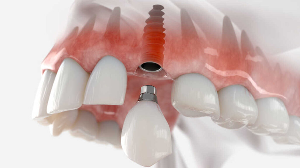 Pesquisadores na Austrália buscam melhorar os resultados dos implantes dentários