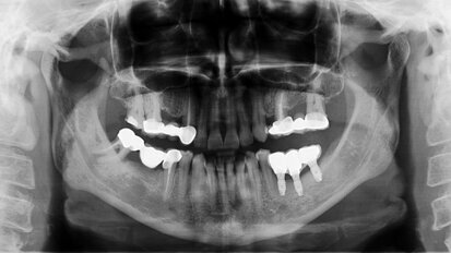 Guided bone regeneration around one-stage nonsubmerged dental implants with bone defects