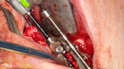 Tecnica completamente guidata nella riabilitazione del mascellare atrofico con impianti zigomatici