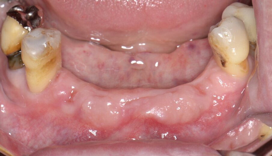 Fig. 1 - Immagine preoperatoria dell’area edentula.