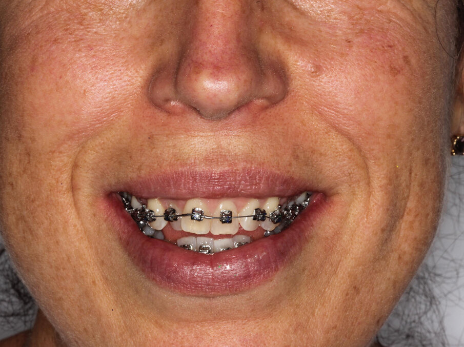 Initial treatment