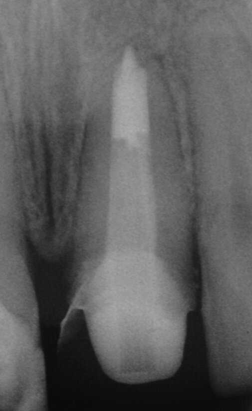 Fig. 2g: (a) Endodontically treated tooth with fistula. (b) After retreatment, the tooth showed an open apex. (c) MTA application with the MAP System and PD MTA White. Condensation of the MTA with pluggers (d) or paper points (e). (f) MTA plug. (g) Post-op radiograph showing the MTA plug and the reconstruction with a fibre post.