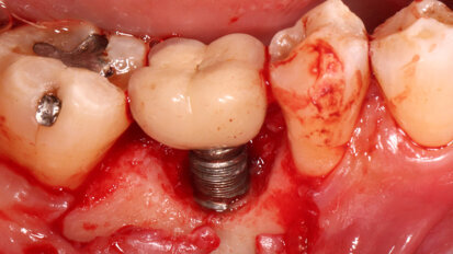 Study determines reasons for dental implant failure and removal techniques