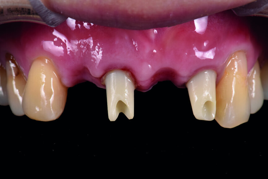 Fig. 42: The titanium-based zirconia abutment.
