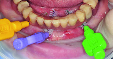 Prevention 0: The best way to prevent peri-implant disease?