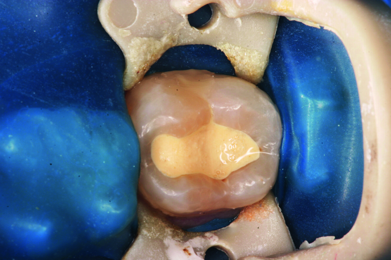 Fig. 3 : Technique Bio-Bulk Fill avec Biodentine.
