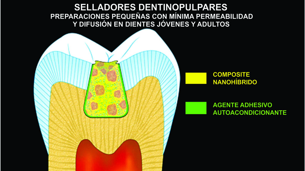 Metodología del sellado dentinopulpar (Segunda parte)
