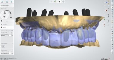 Kompleksowa terapia implantologiczna z zastosowaniem CBCT, technik augmentacyjnych i CAD/CAM