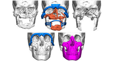 Planmeca ProModel technology part of first Nordic facial tissue transplant
