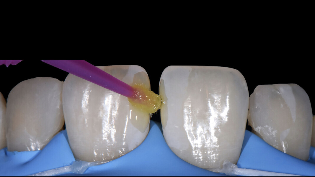 Fig. 7: Application of the bonding agent to the surface of the enamel.