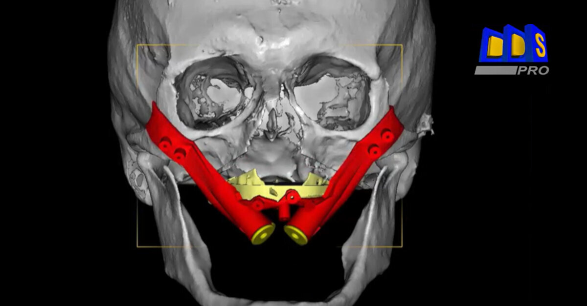 Polorto – DDS-Pro – Navigating Zygomatic Implants and Osteotomy in one ...