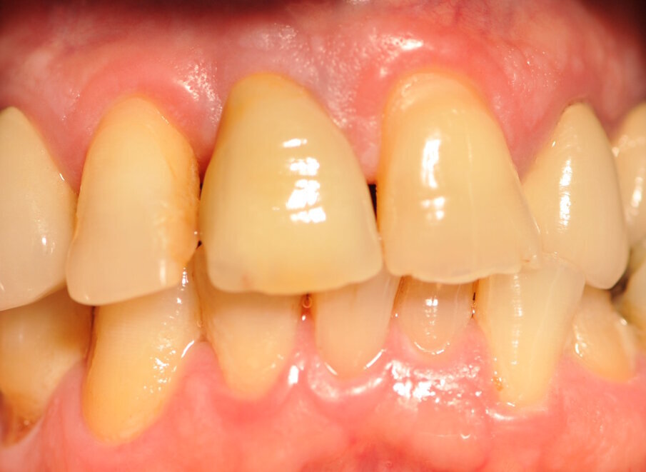 Fig. 10_Corona definitiva appena cementata con tecnica extraorale.