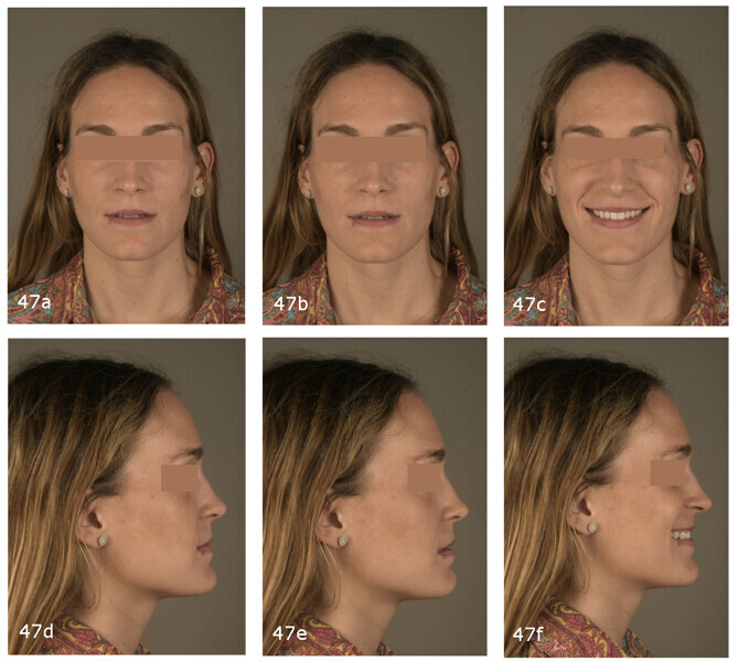 Figs. 47a–f: Post-treatment extra-oral photographs.