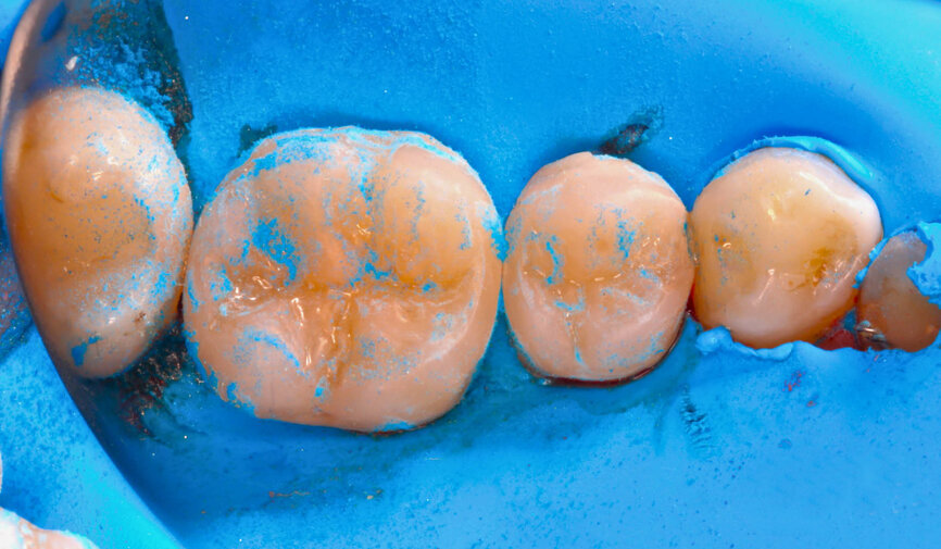 Fig. 5: Once the excess composite has been removed, polishing should start with the dark-blue TWIST DIA for Composite rubber spiral (Kuraray Noritake Dental). 
