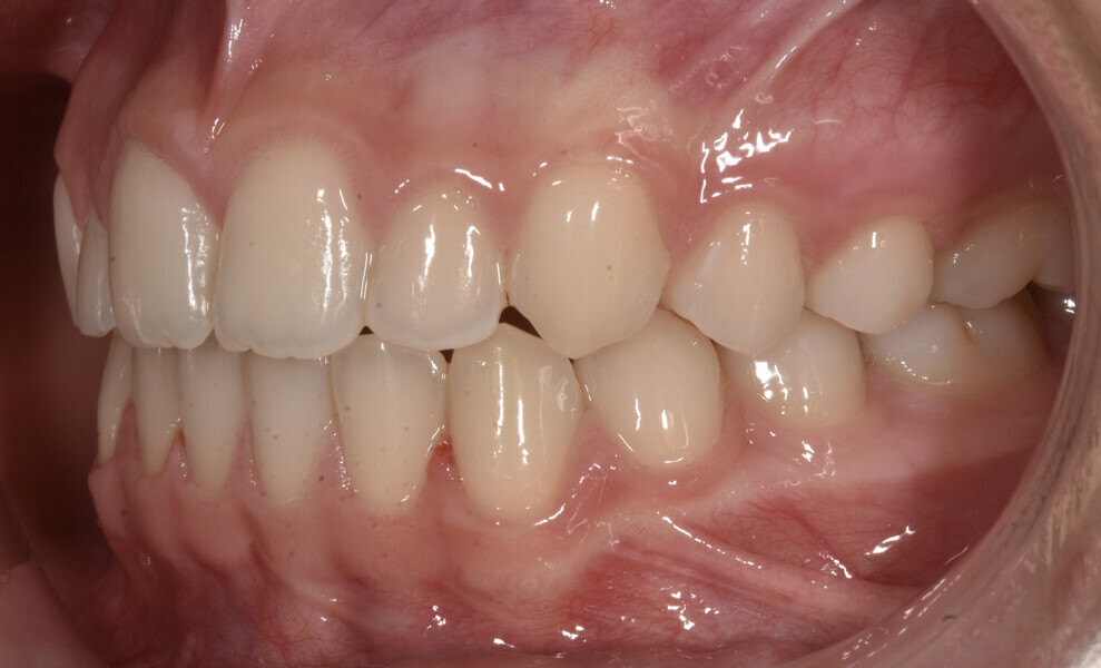 Fig. 7: Facial and intra-oral photographs after treatment with fixed orthodontic appliances.
