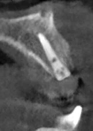 Fig. 19: CBCT cross-section following implant placement demonstrating adequate width to house the implant and sufficient facial plate thickness.