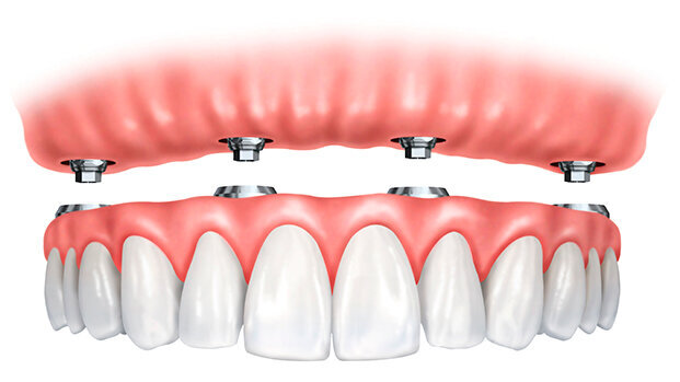 Overdentures su impianti: riabilitazione ancora attuale?