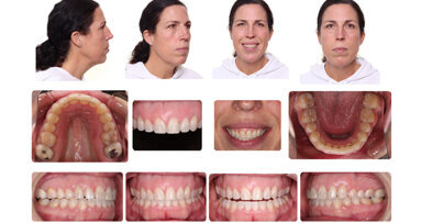 Case study: Class I crowded malocclusion with moderate maxillary and mandibular crowding