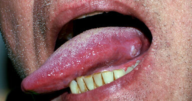 Tongue cancer: Researchers find possible markers for earlier diagnosis