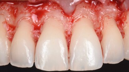 Progettazione della terapia chirurgica dell’eruzione passiva alterata: l’evoluzione digitale
