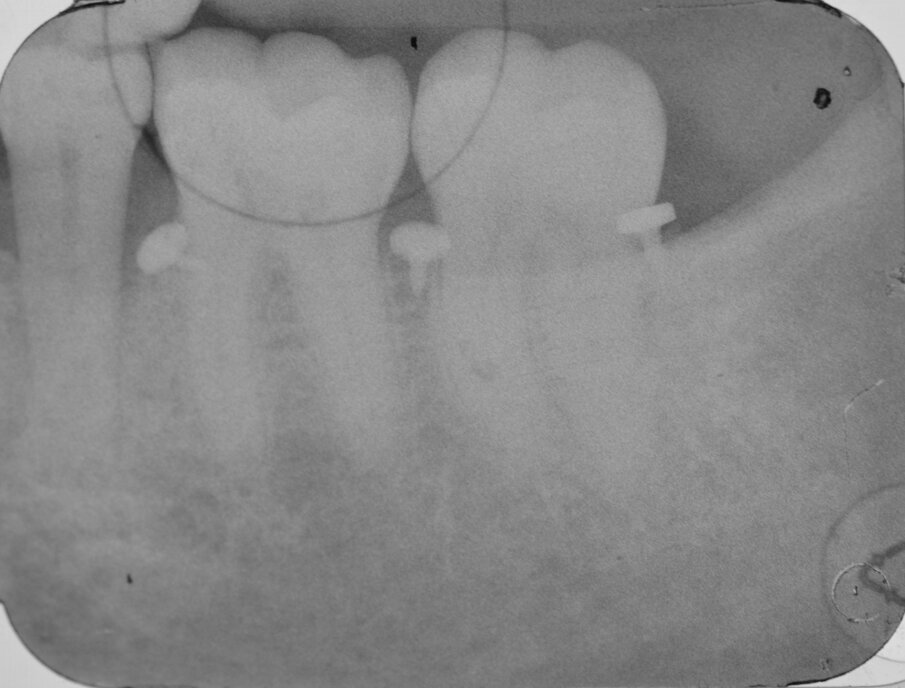 Fig. 15 - RX postoperatoria che evidenzia la completa rigenerazione del difetto osseo (follow-up a 24 mesi).