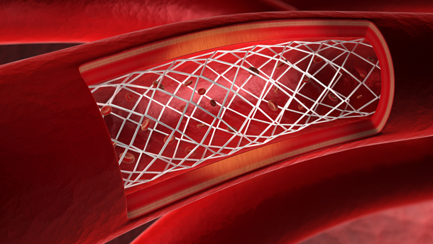 Parodontitis begünstigt Arterienverkalkung