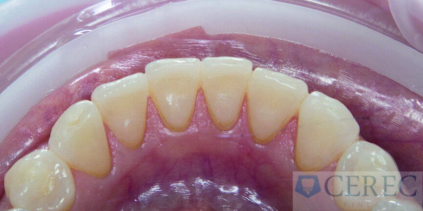 Fig. 10: Perfect adaptation of the veneers with optimal margin design.