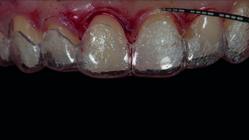 Figs. 6b : Adaptation intraorale du guide chirurgical utilisé pour l‘élongation coronaire.