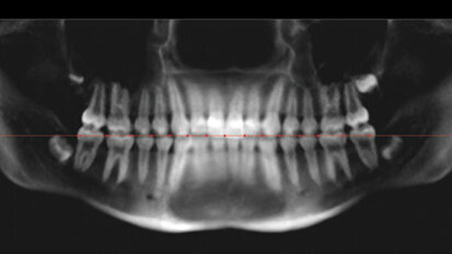 Comparison of tooth mesiodistal angulation measurements