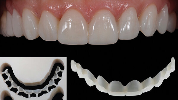 Fig. 12b. Restauraciones provisionales intraorales (Telio CAD).