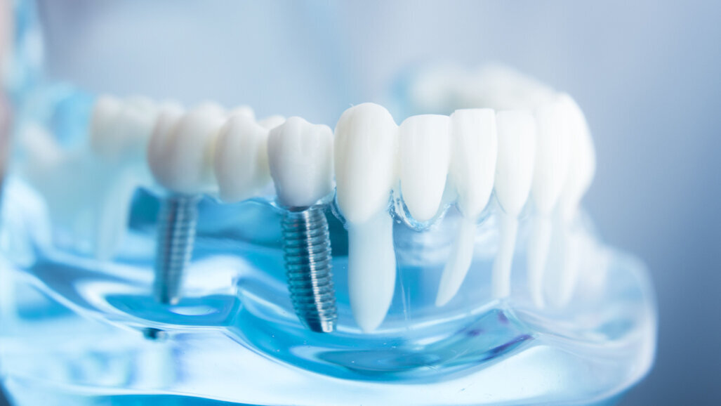 UCLA researchers develop technology to dramatically reduce peri-implantitis