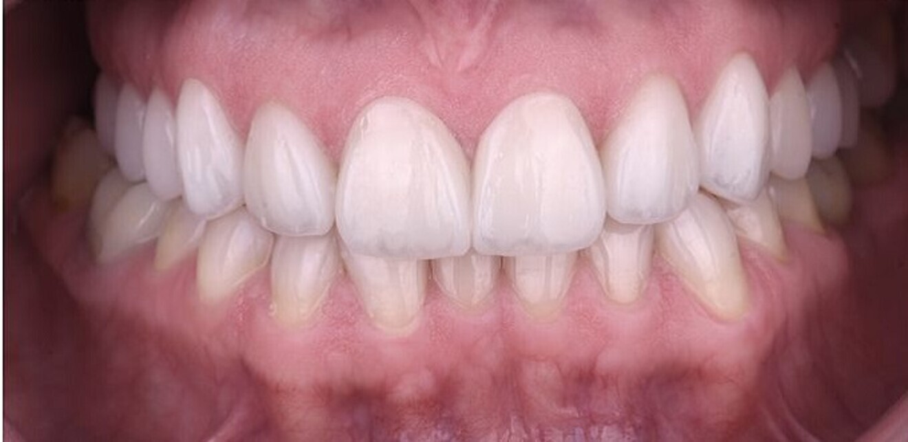 Fig. 10b: Post-op intra-oral view with the teeth in maximum intercuspation.