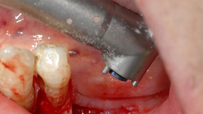 Il laser a Erbio in odontoiatria: applicazioni e vantaggi