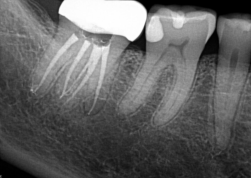 Fig. 20b: Note the attention to detail required to locate all of the canals in this exceptional case done under the surgical microscope. (Courtesy of Dr. Adrian Silberman)