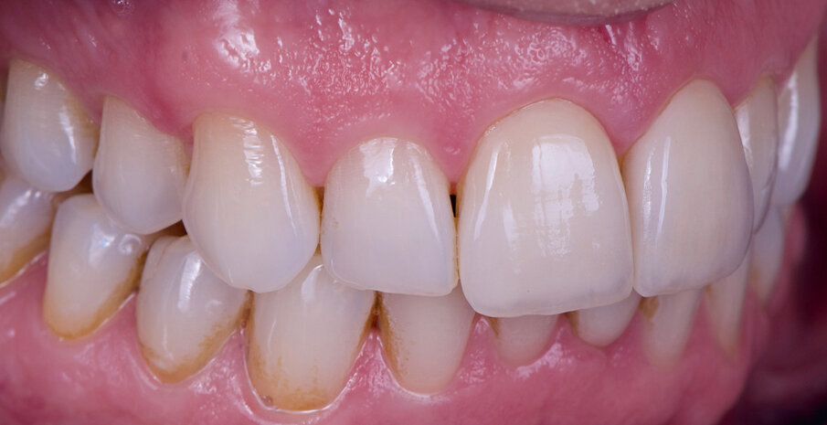 Fig. 11 & 12: Veneers on the UR 1 and UL 1: The brightness value of the adjacent teeth has been reproduced exactly. There is a natural in-depth effect within a minimal layering thickness.