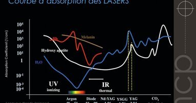 La microchirurgie parodontale d’assainissement: une nouvelle approche avec le laser Erbium-YAG