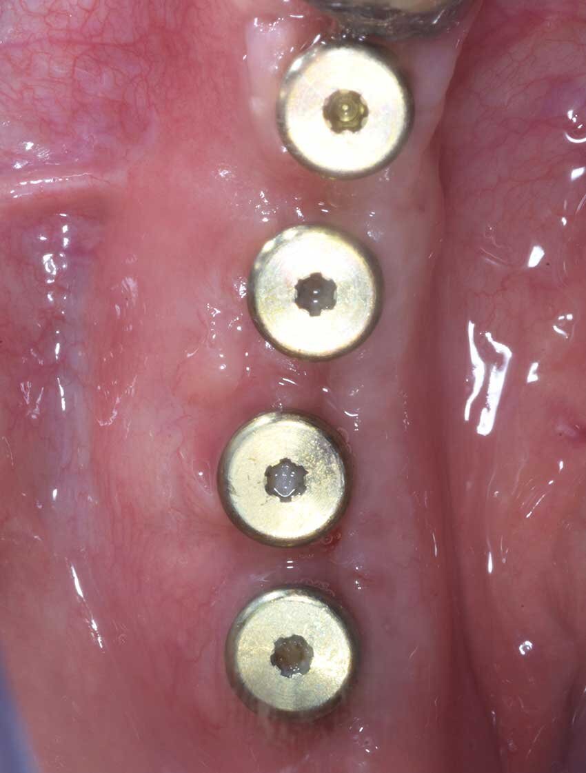 Fig. 13 -Visione occlusale della cresta.
