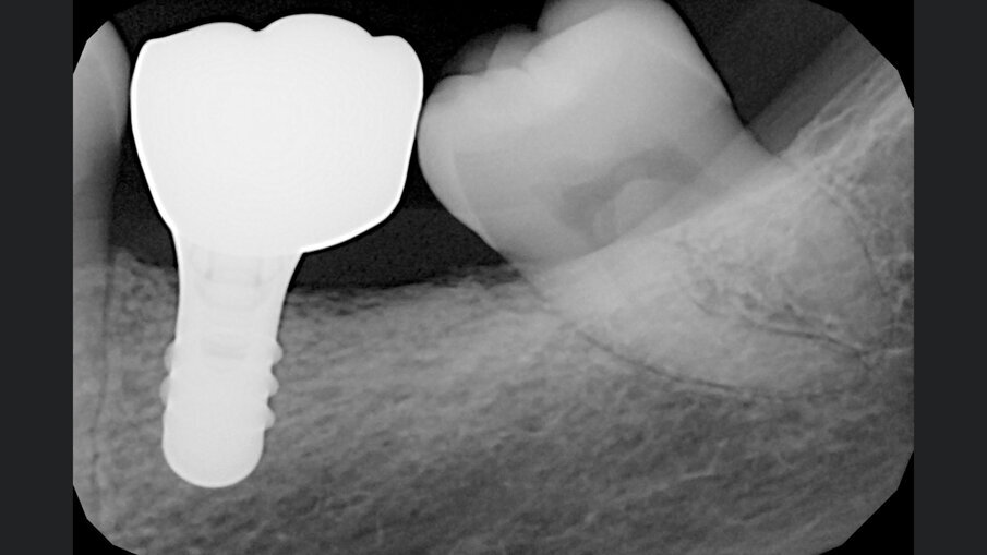 Fig. 9 - RX di controllo a 24 mesi dalla consegna della protesi che mostra l’ottima mineralizzazione dell’osso circostante.