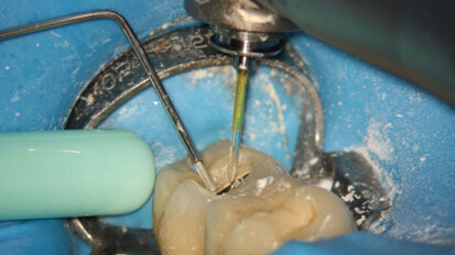 PIPS and retreatment