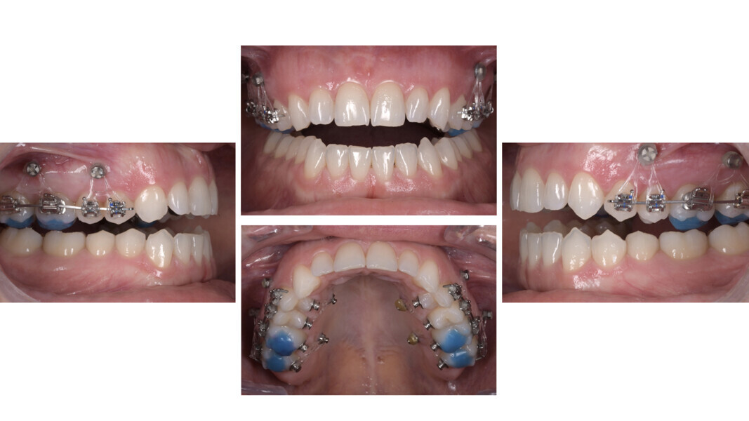 Figs. 43a–d: Sectional mechanics (hybrid approach): bite raisers, tubes, brackets and mini-screws for posterior intrusion.