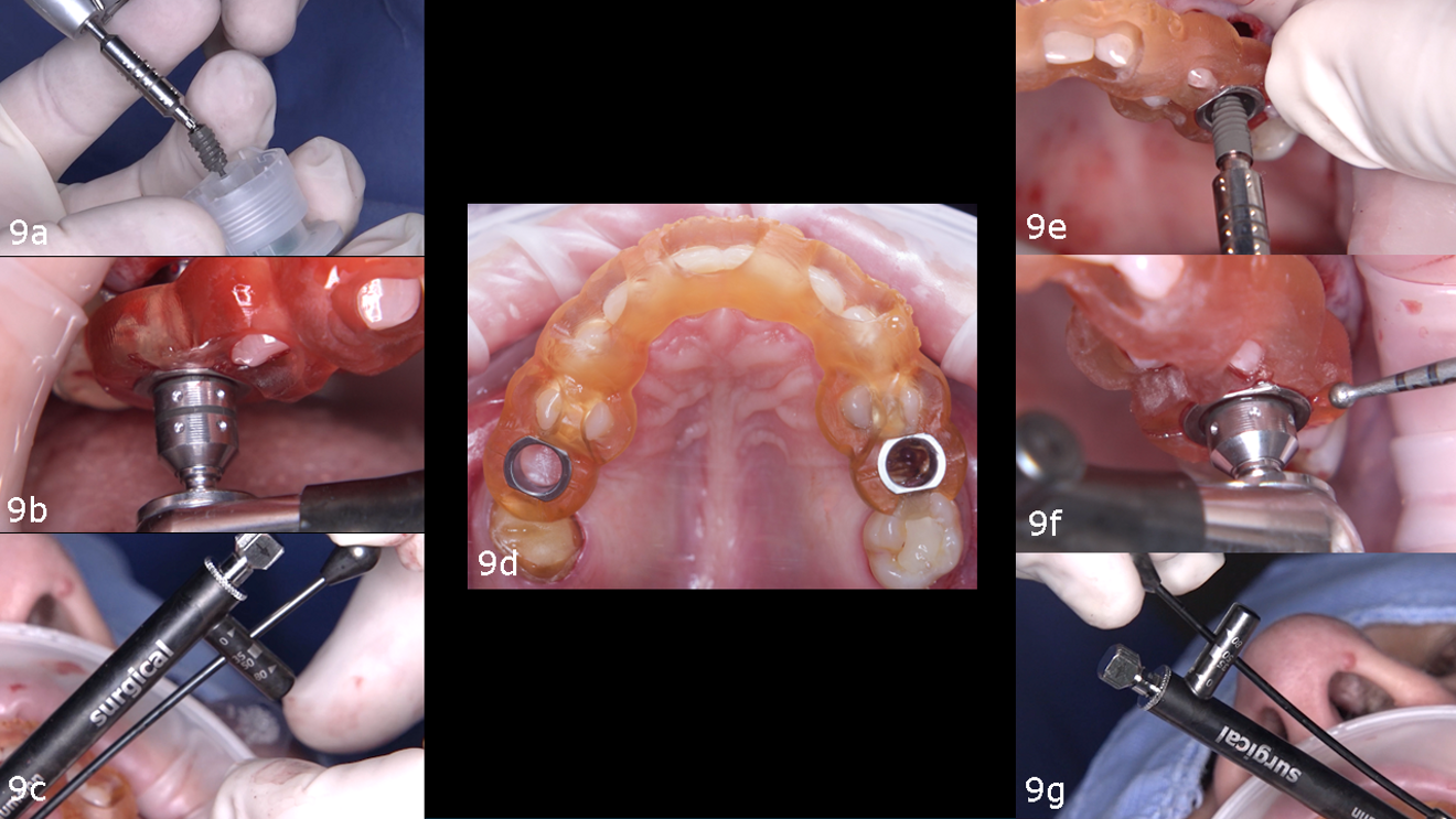 Figs. 9a–g: Straumann BLX implant placed in site #15 (a–c), and Straumann BLC implant placed in site #25 (e–g).